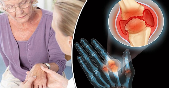 10 Home Treatment for Painful Arthritis Pain At Home In 10 Days