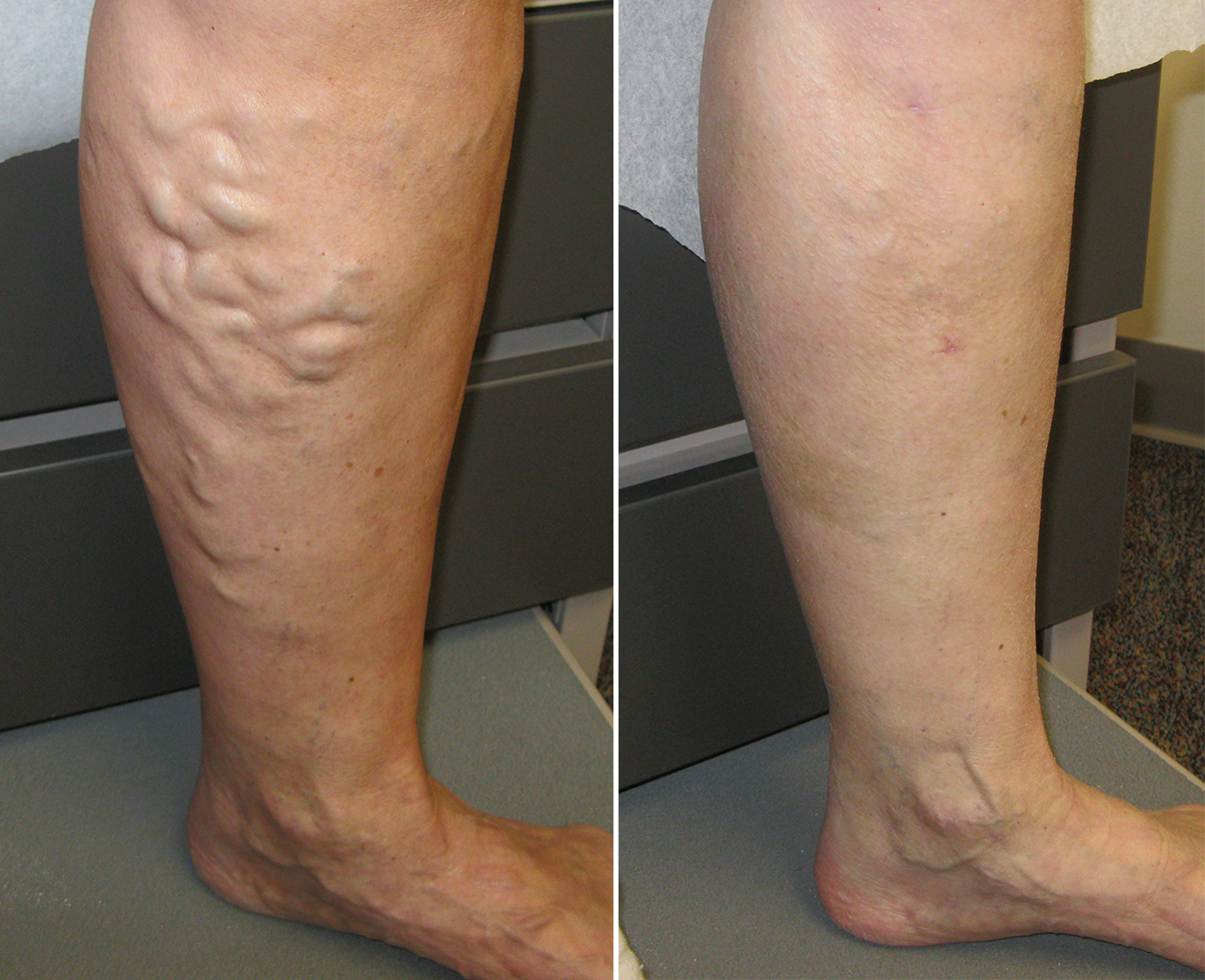 5 Natural Ways To Treat Varicose Varicose Veins For 12 Days