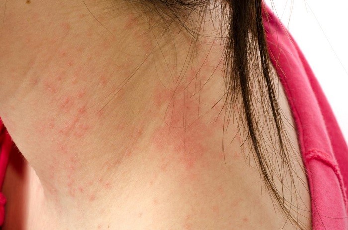 Cure Psoriasis impressively At Home In 12 Days