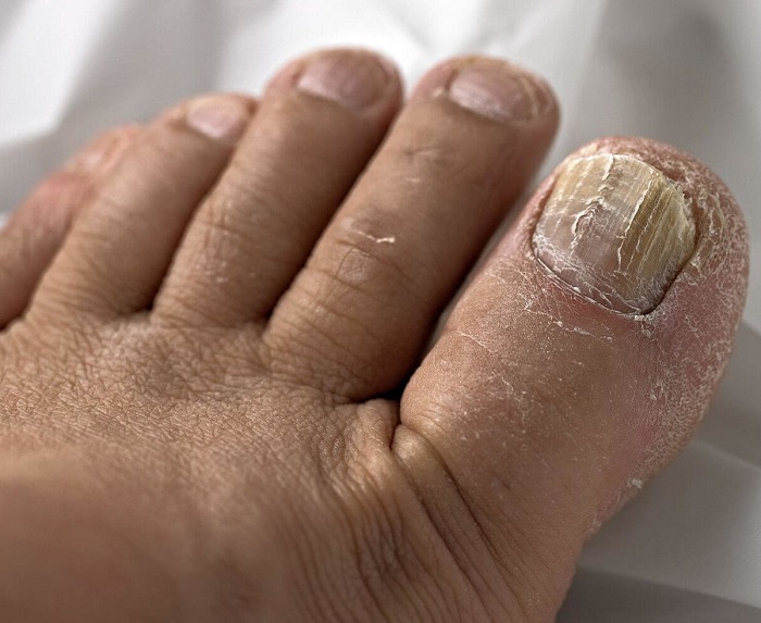 Here are 10 Home Remedies for Onychomycosis in 7 Days