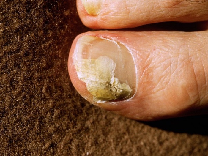 Here are 10 Home Remedies for Onychomycosis