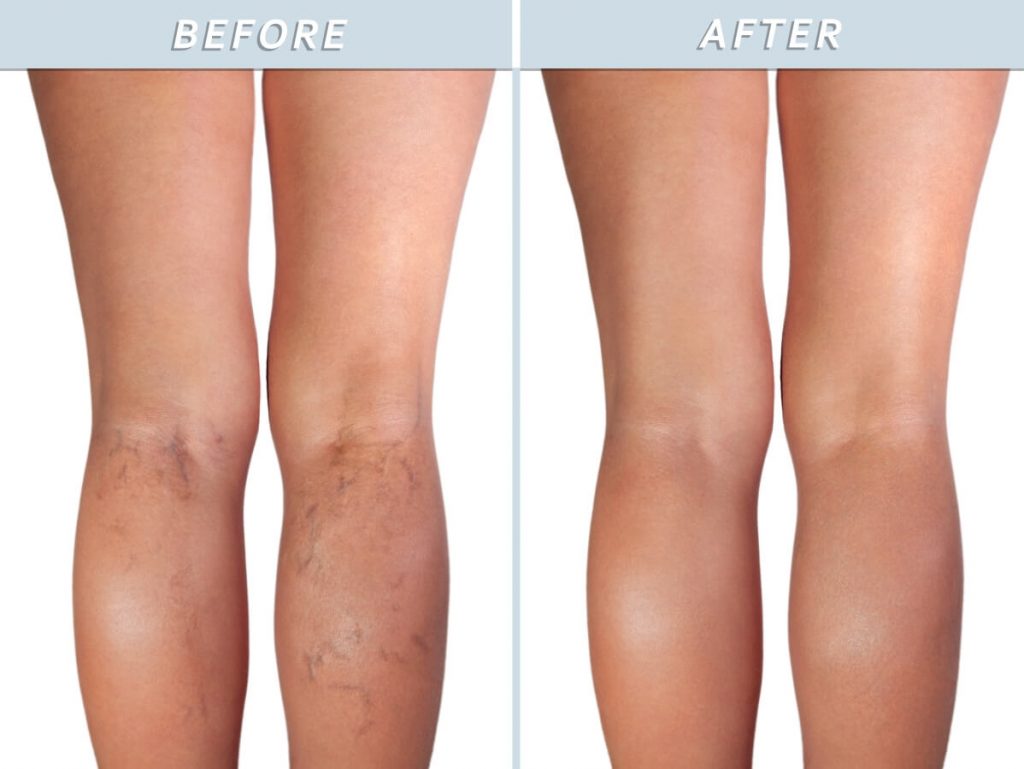 varicose vein treatment