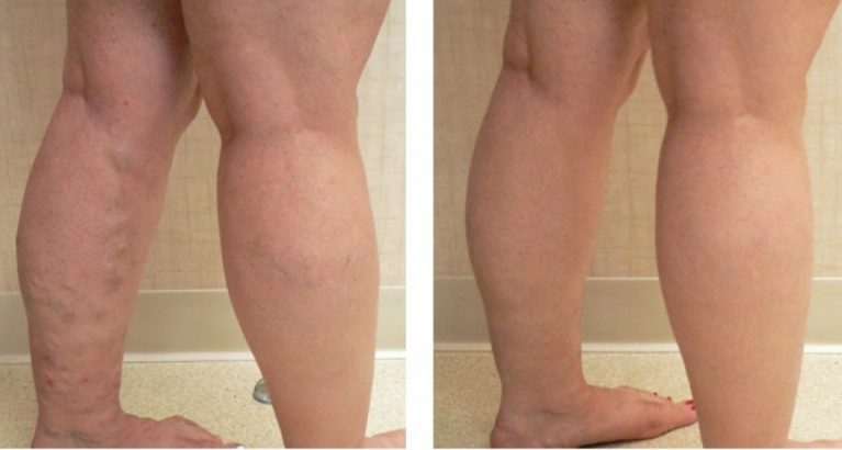 varicose veins buy