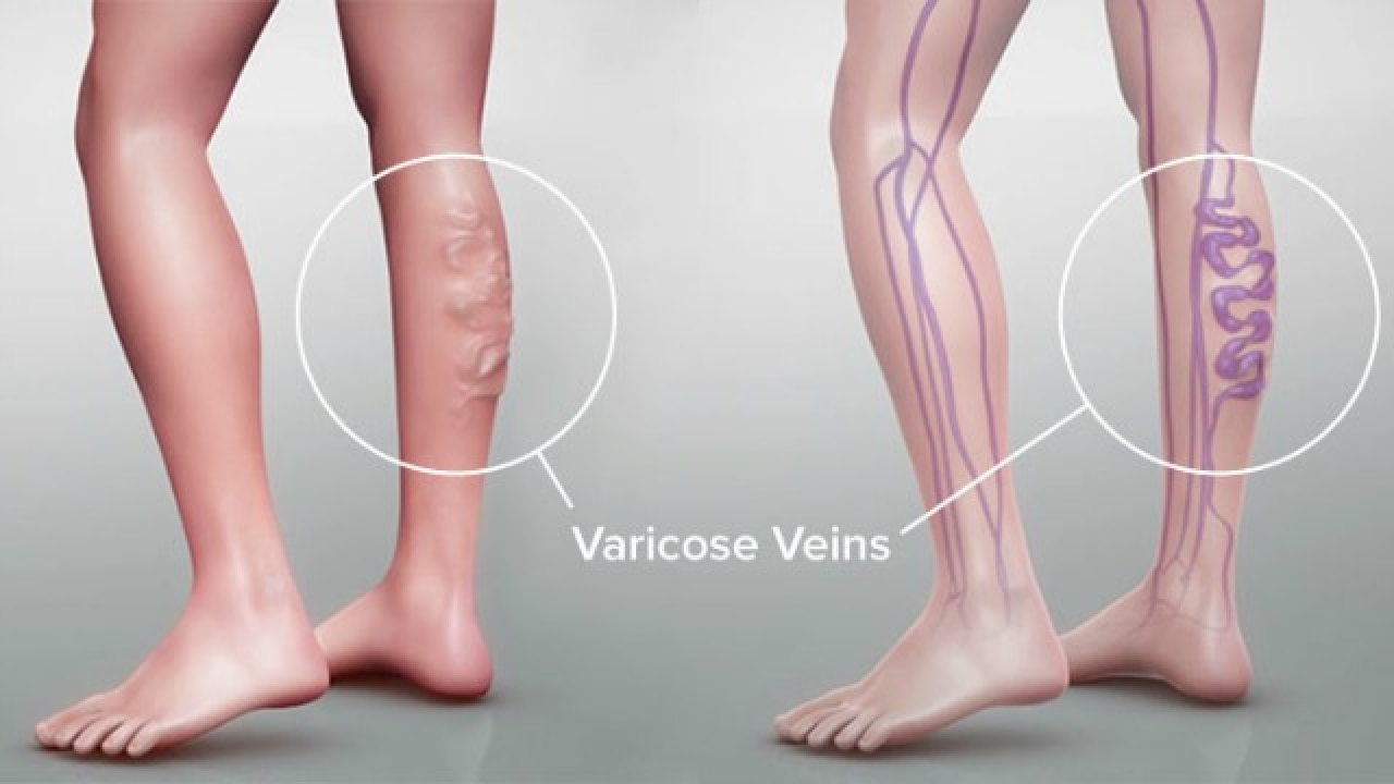 varicose veins