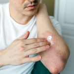 Dermal | Krem për lehtësim të shpejtë nga problemi i psoriazës – [Përditëso]