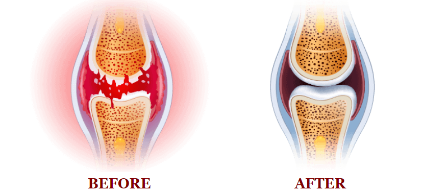 Joint Pain Relief